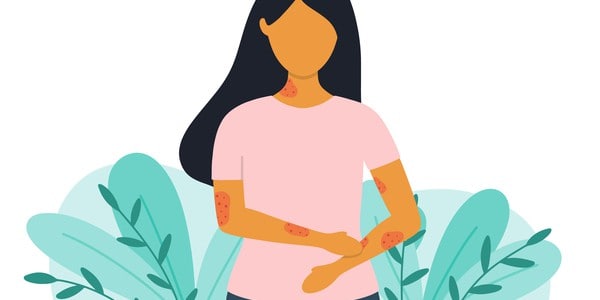 Health-Resource-Psoriasis