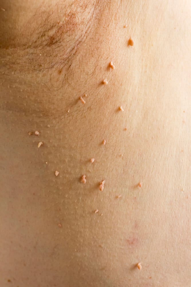 skin tags blog