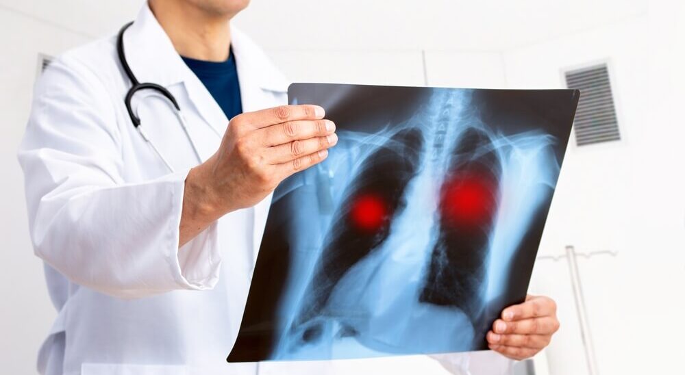 A Guide to Pneumonia Causes, Symptoms & Prevention