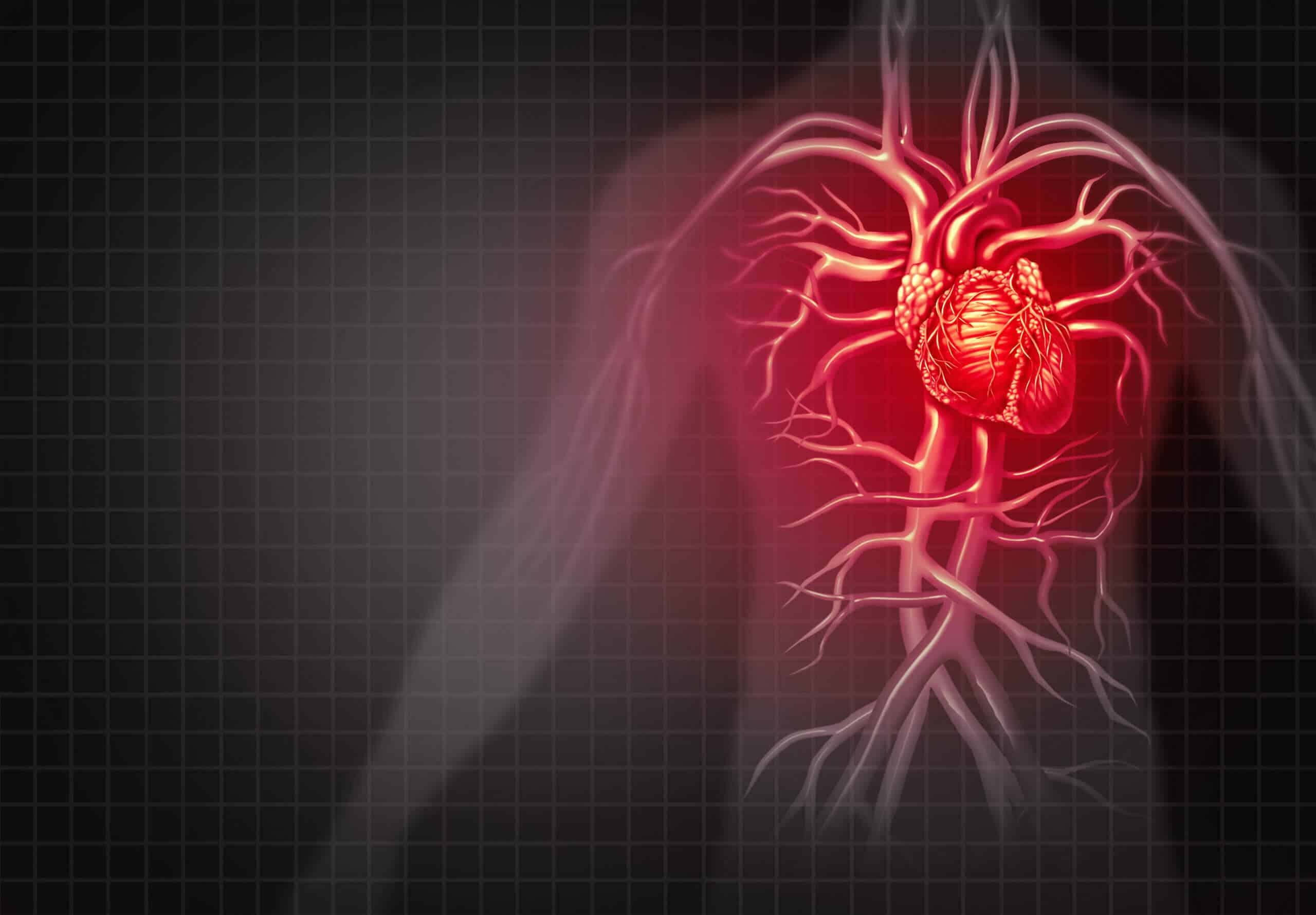 Sudden Cardiac Arrest: What is it?